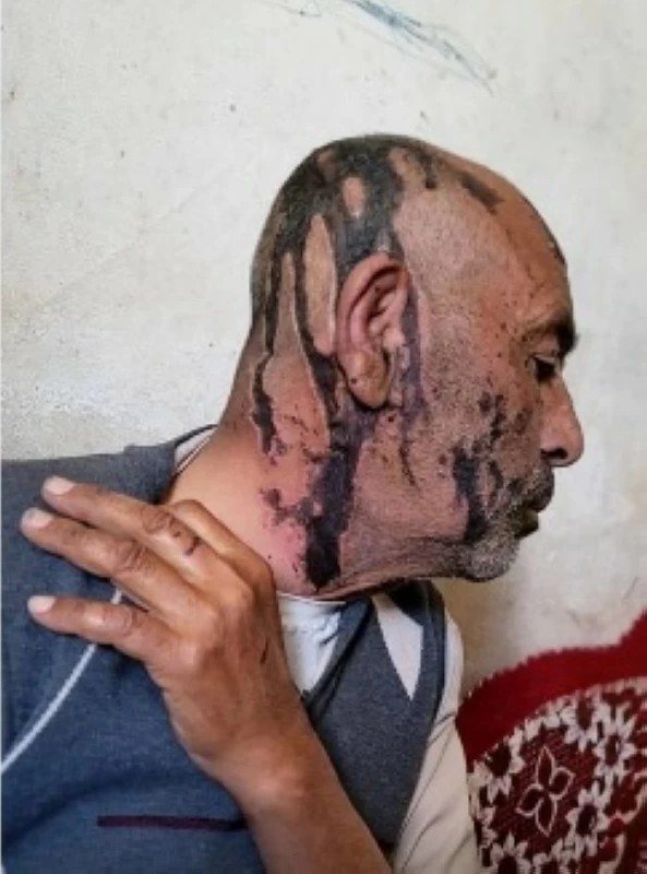 مسلحان حوثيان يحرقان والدهما بـ“الأسيد” ومشرف أمني يرفض ضبطهما